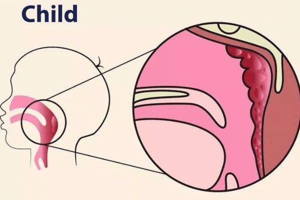小儿腺样体肥大具体是如何形成的呢？